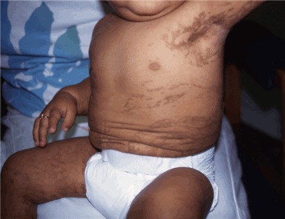 incontinentia Stage rash