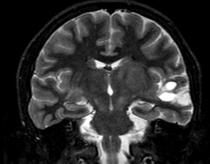 Neurofibroma bright objects