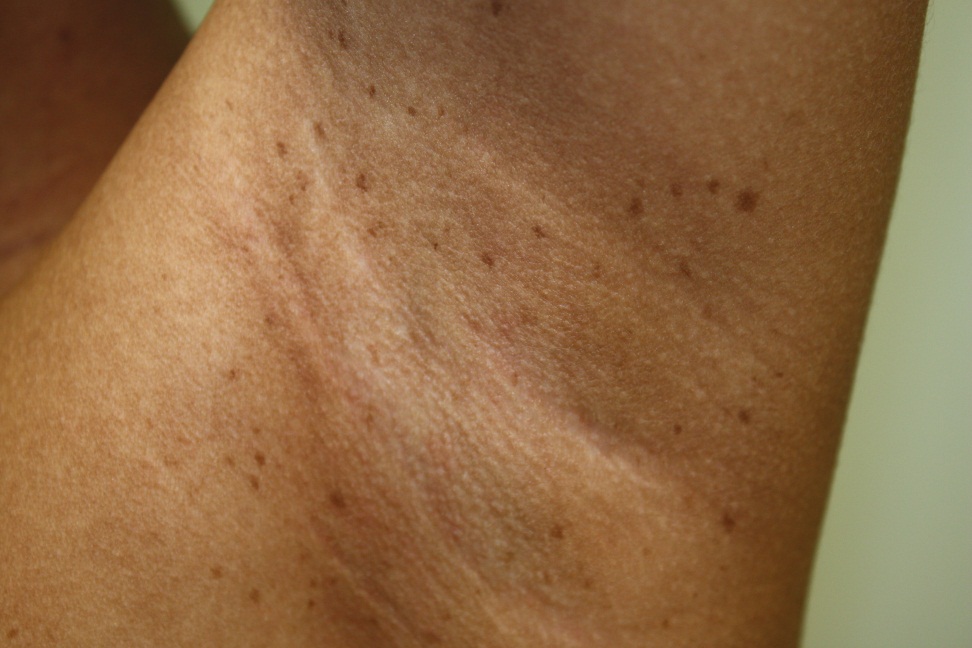 Plexiform Neurofibroma