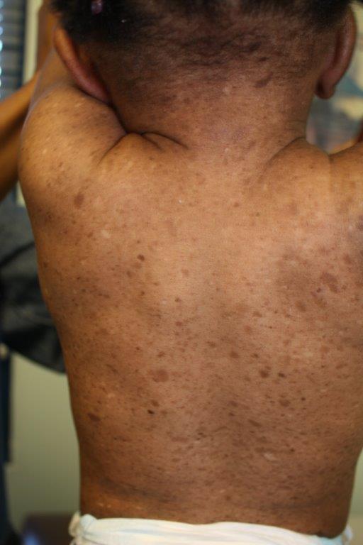 Café au Lait Macule