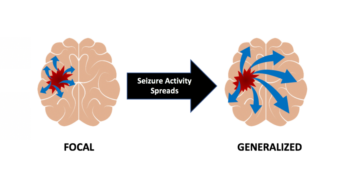 brains showing focal versus generalized seizure activity