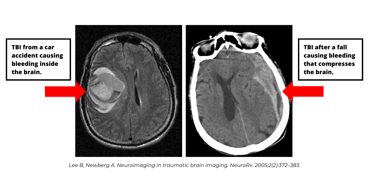 Traumatic brain injury shown in brain scan car accident and fall causes