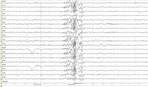 EEG graph